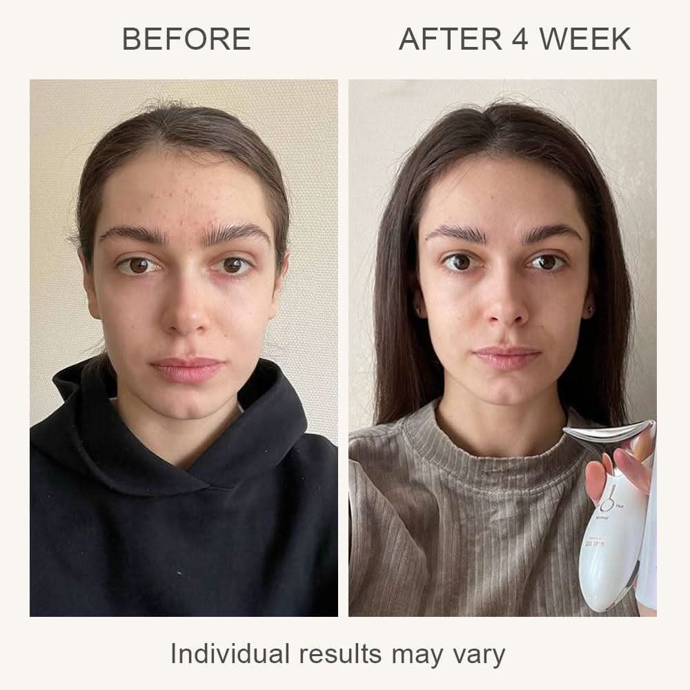 EELHOE Ζεστή & Κρύα Συσκευή Ομορφιάς